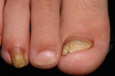 Micosa de uñas nas pernas