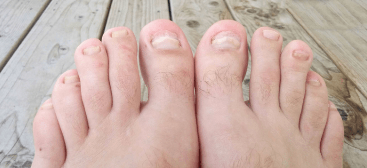Fungo das uñas