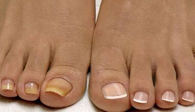 As causas da aparición do cogomelo nas uñas