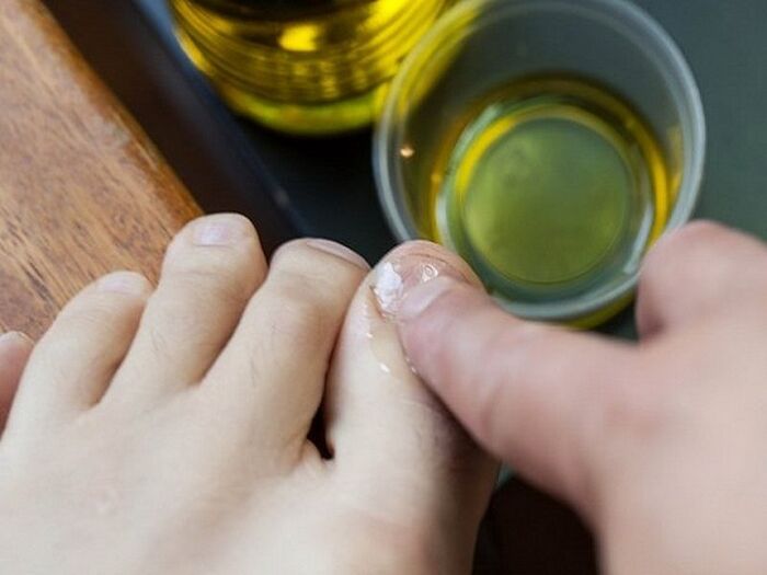 Aplicar aceite medicado ás uñas afectadas por fungos