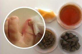 Tratamento do fungo das unhas dos pés con remedios populares