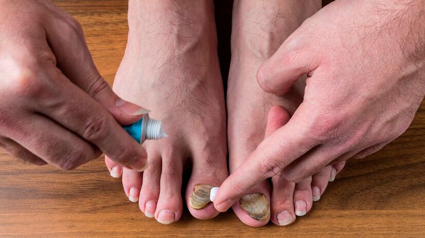 Aplicar unha crema antifúnxica nas uñas dos pés para tratar a onicomicose